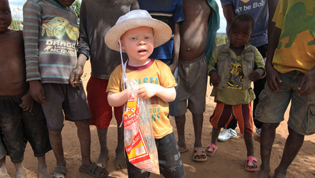 Malawi : les albinos vivent dans la terreur 