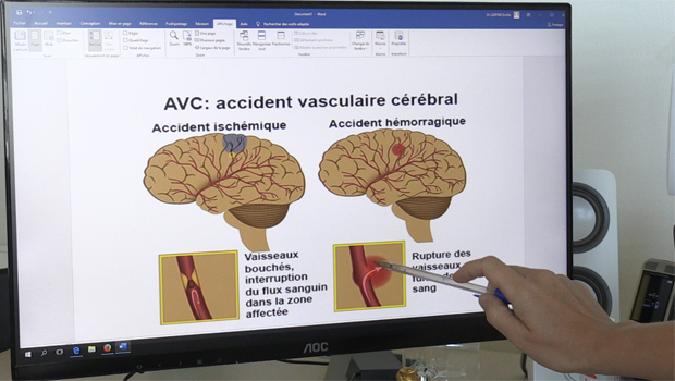 Arrêt cardio-vasculaire - La Réunion - AVC