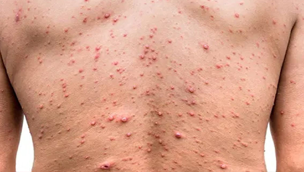 La variole du singe : les personnes contaminées devront se confiner pendant 21 jours