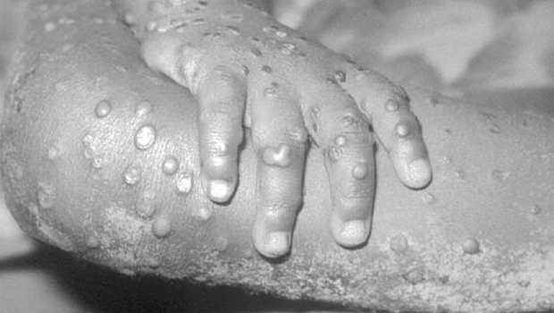 Au moins 3 cas confirmés de la variole du singe en France : les muqueuses de la bouche et de la région génitale sont touchées 