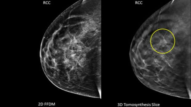 La mammographie  3D, un dépistage sure du cancer des seins