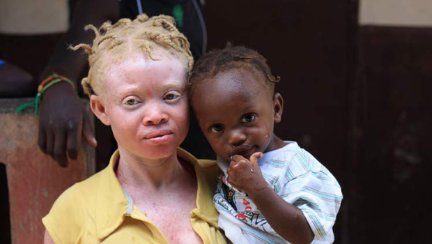 albinos 